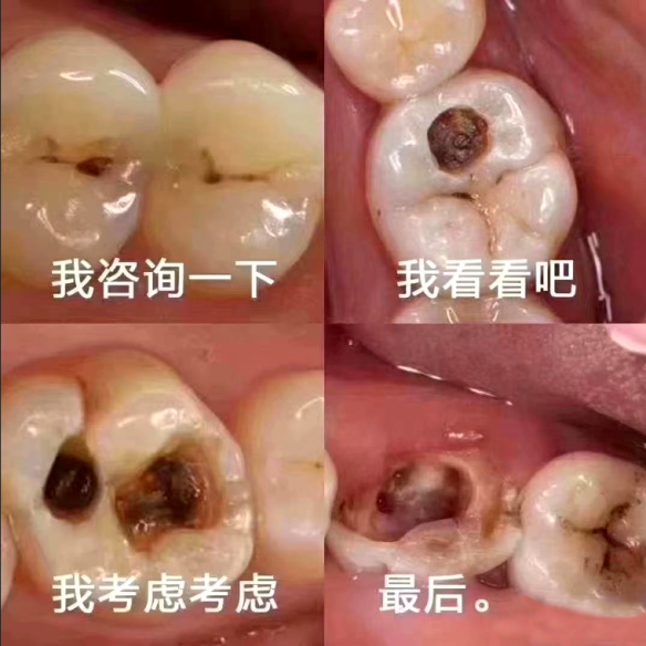 龋齿拖着不补的后果蛀牙不仅会导致牙齿疼痛,长期蛀牙还会导致龋洞