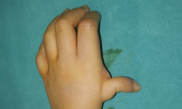 小孩子大拇指发育不良漂浮指,可以通过手术进行改善吗