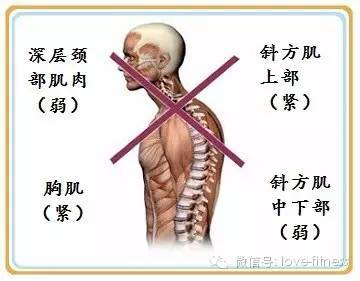怎样缓解和改善上交叉,下交叉综合症?