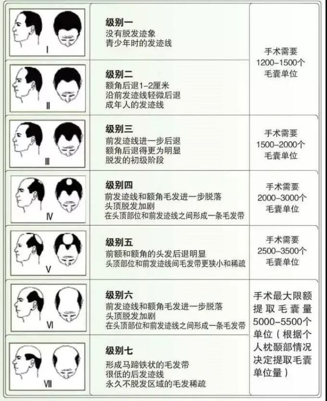 汉密尔顿-诺伍德量表将男性脱发分为12 种类型,7 个等级(图源:中国