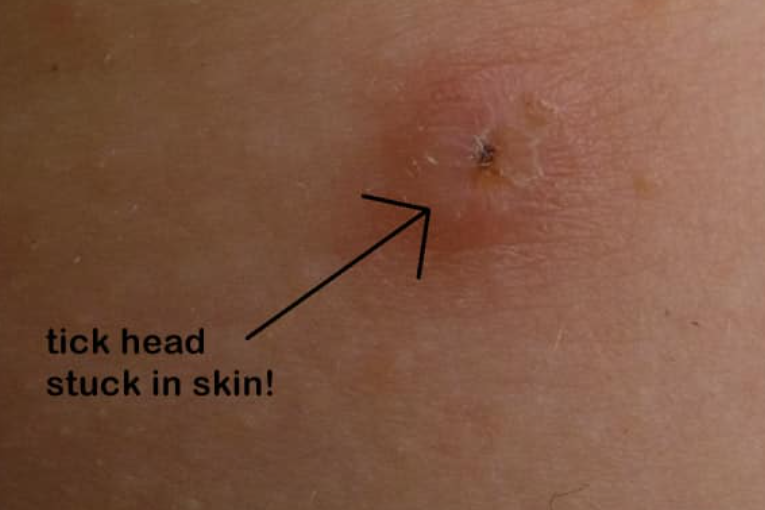 在叮咬和吸血的整个过程中,蜱虫会咬破人体的皮肤,并且向局部注射