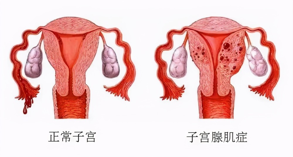 异位本来应该生长在子宫内的内膜,但是会引起输卵管,卵巢,盆腔腹膜