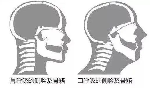 孩子成长发育的每一步都是不可逆的,2~10岁是治疗孩子口呼吸的黄金