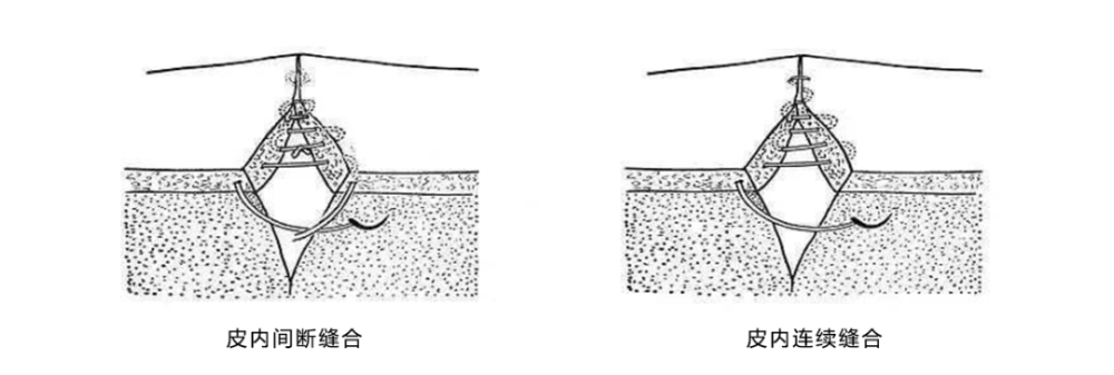 皮内缝合