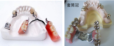 稳定的一类修复体,它结合了固定假牙和活动假牙的一些优点,对于缺牙