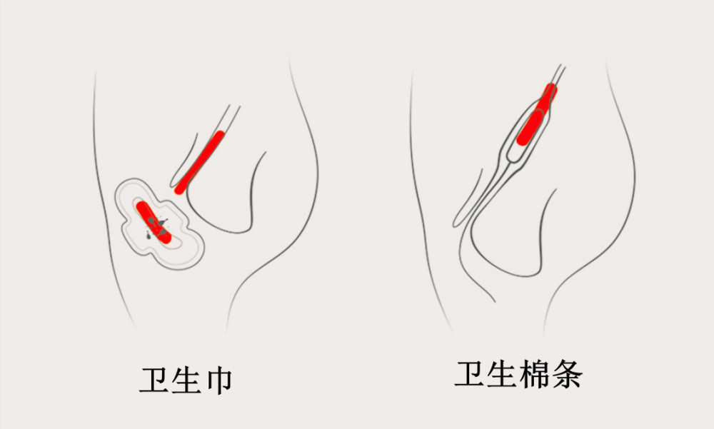 为何我国女性喜欢用卫生巾外国女性却独爱卫生棉条两者有什么区别