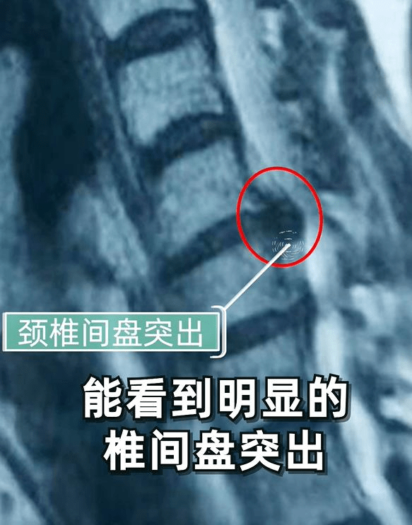 深圳颈椎间盘突出的福音椎间盘镜微创手术
