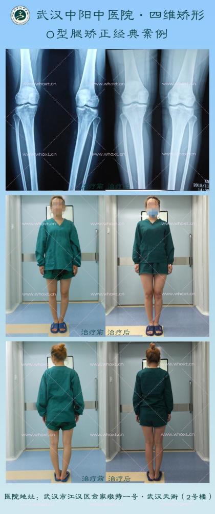 改善下肢异常受力,纠正力线,恢复关节正常角度,由此达到矫正o型腿的