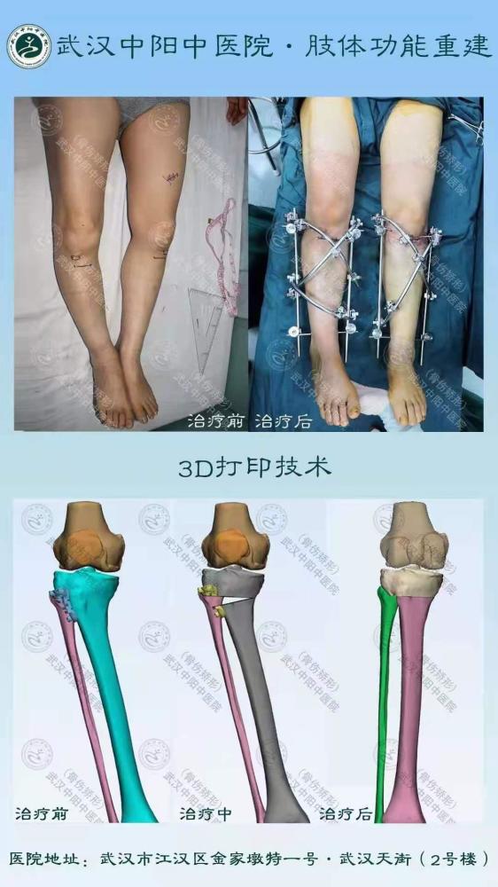 多例临床案例表明,截骨手术对矫正骨性改变o型腿效果显著.