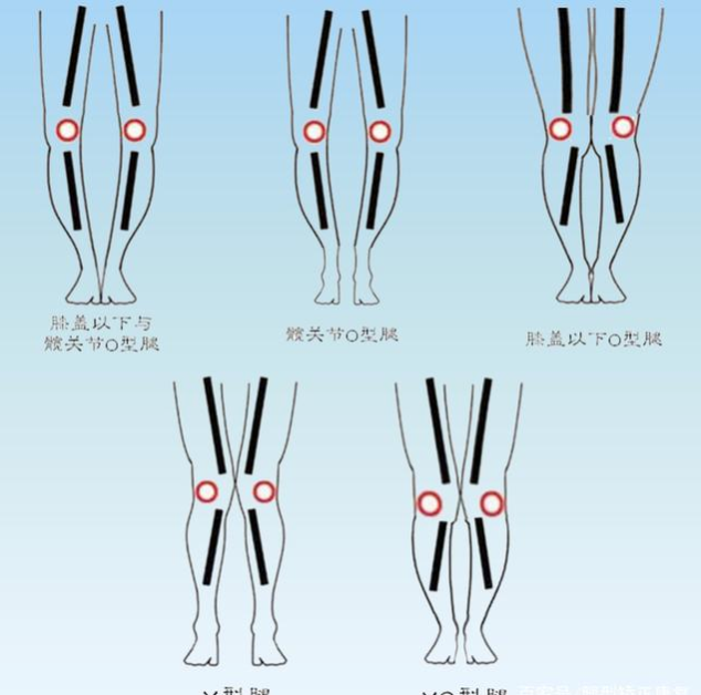 长期穿高跟鞋,盘坐,跪坐,蹲马步等等长期错误的姿势造成的假性o型腿