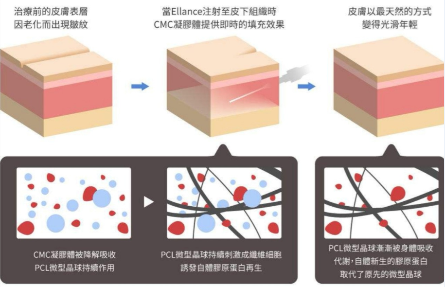 少女针有三重效果,第一重,cmc凝胶载体立即填充效果;第二重,pcl微型晶