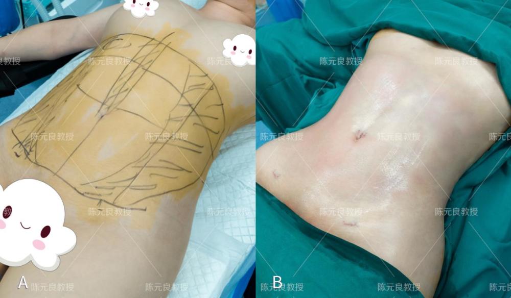 抽脂排名_抽脂手术