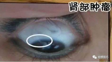 5,颈椎疾病:眼睛上端发现锯齿状血丝要预防颈椎疾病.