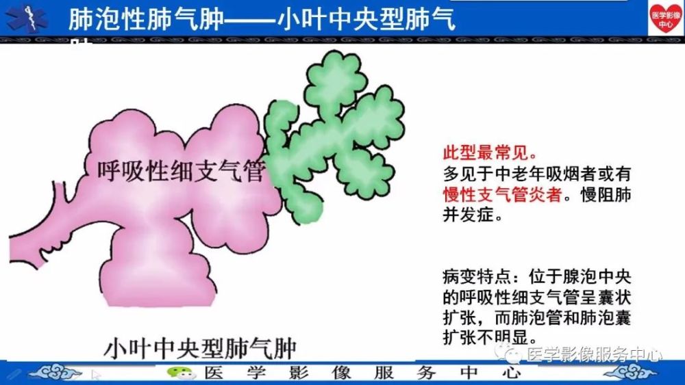 肺气肿的分型及ct表现