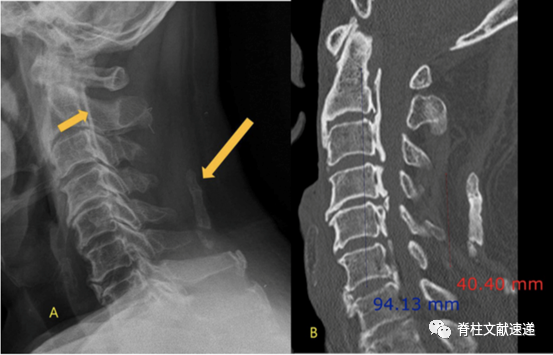局灶型项韧带骨化的位置与椎体骨赘的大小有关; 3.