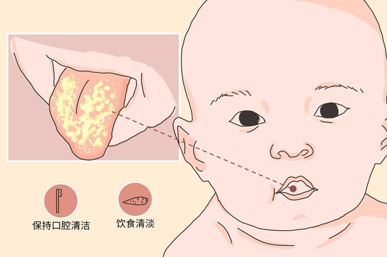 2,好发于颊,舌,软腭及口唇部的黏膜,白色的斑块不宜用棉棒或湿纱布