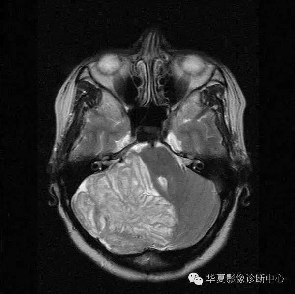 这6 种典型影像征象的病变你都认识了吗