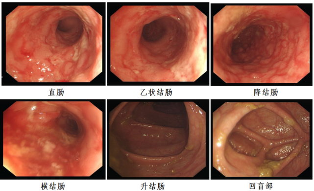 两例重度溃疡性结肠炎患者不同的"达标治疗"之路:蜿蜒