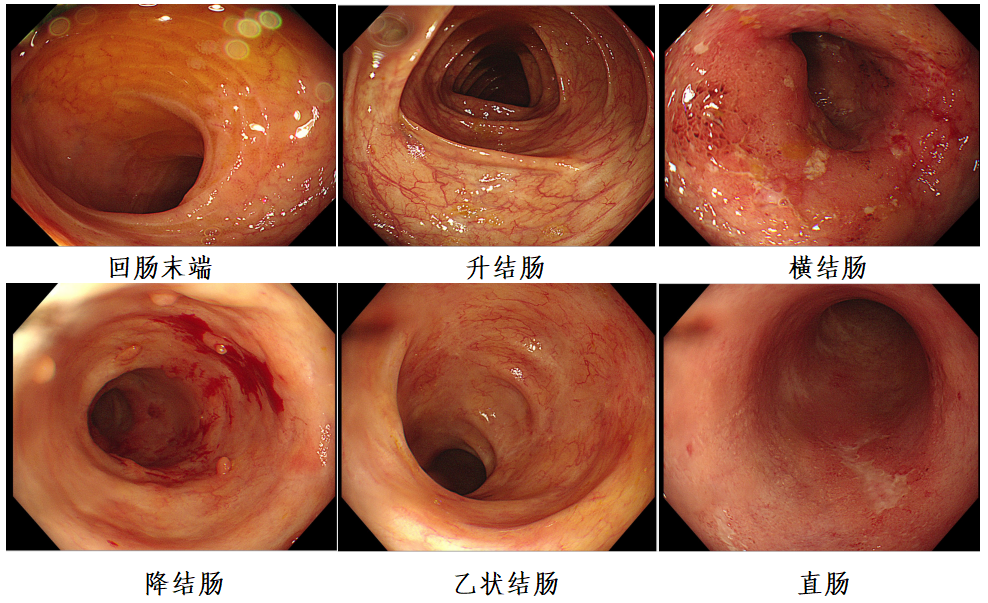 两例重度溃疡性结肠炎患者不同的达标治疗之路蜿蜒曲折vs长驱直入