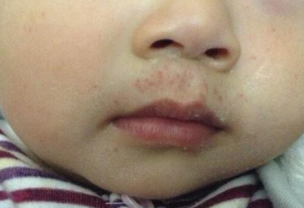 婴儿口水疹和湿疹的区别,婴儿口水疹怎么处理?答案在这里!