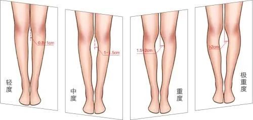 常态膝距指的是直立时两足踝部靠拢,双腿和膝关节放松时,双膝关