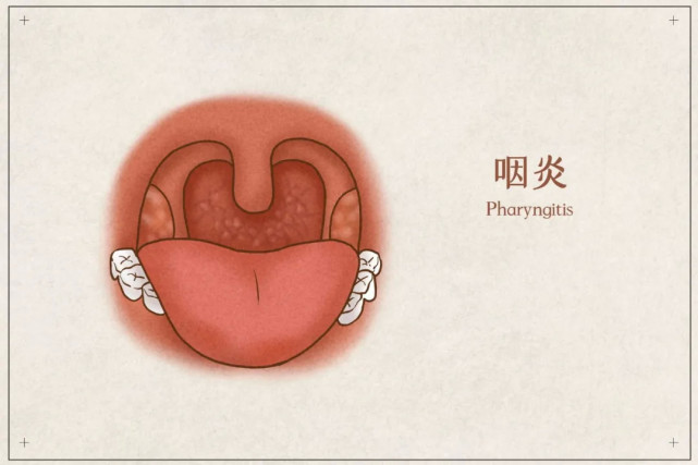 咽干咽痒,咽喉老觉得有东西,吃点火锅就觉得嗓子在冒火,咳嗽,早起就