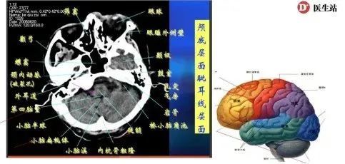 在接下来这节课中,唐伟老师将为我们详细介绍不同层面的头ct解剖结构