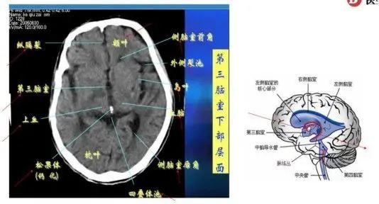 唐伟老师将为我们详细介绍不同层面的头ct解剖结构,基底节区的解剖和