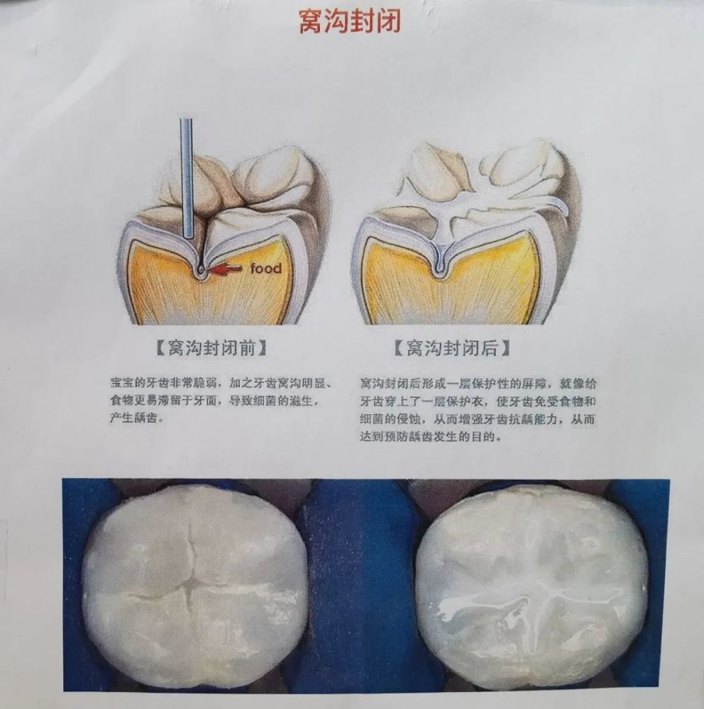 免费做窝沟封闭!