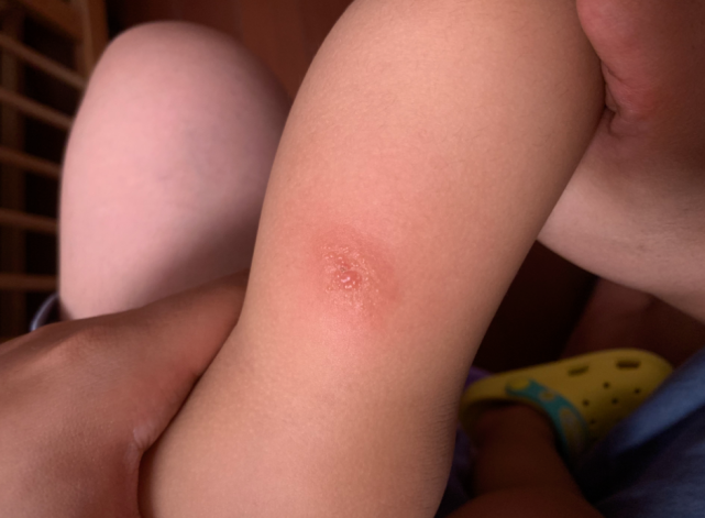 宝宝被蚊子叮咬后引起皮肤红肿硬起水泡,怎么办?