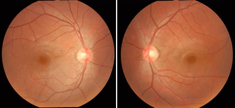 4,视野检查:视野是诊断青光眼的一项重要检查,青光眼在视盘出现病理性