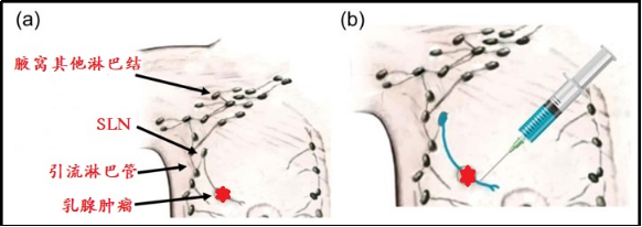 这样改进荧光示踪剂让早期乳腺癌前哨淋巴结活检更方便