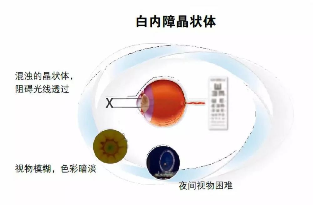 营养障碍和代谢失常而逐渐发生混浊,视力逐渐减退产生并发性白内障