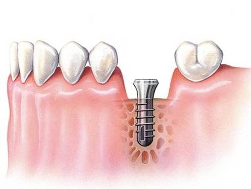 待骨结合后,接着安装愈合基台,使种植体穿出牙龈,等待2-3周后,软组织