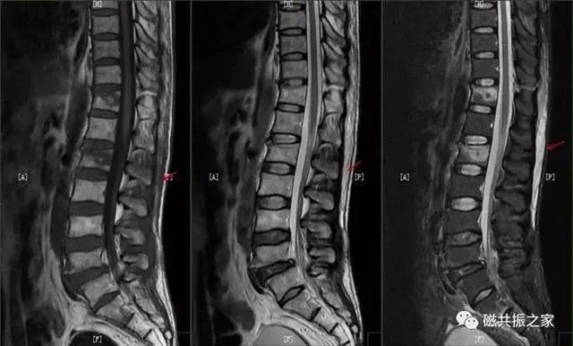 03主要表现:棘间韧带变性/棘间韧带炎症主要表现:在压脂t2wi图像上棘