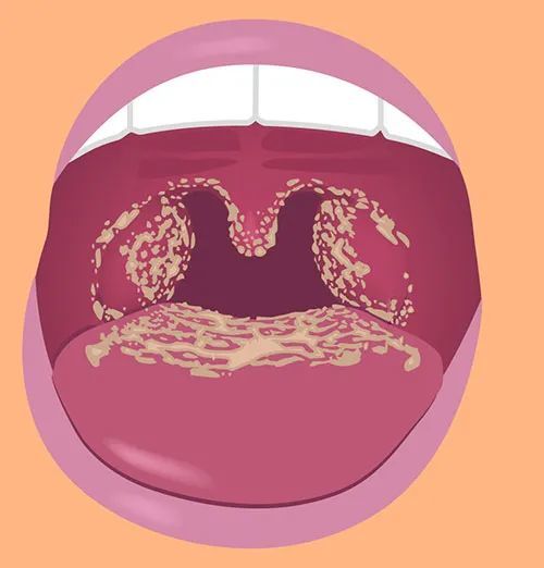 念珠菌感染可能发生在口腔,喉咙等位置(图片来源:参考资料[3])