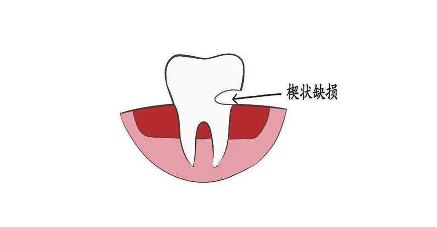 闫燕医生:牙齿楔状缺损如何预防治疗?
