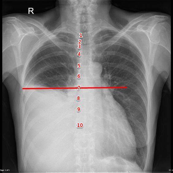 胸片,ct,b超如何定位胸水?这11张图告诉你!