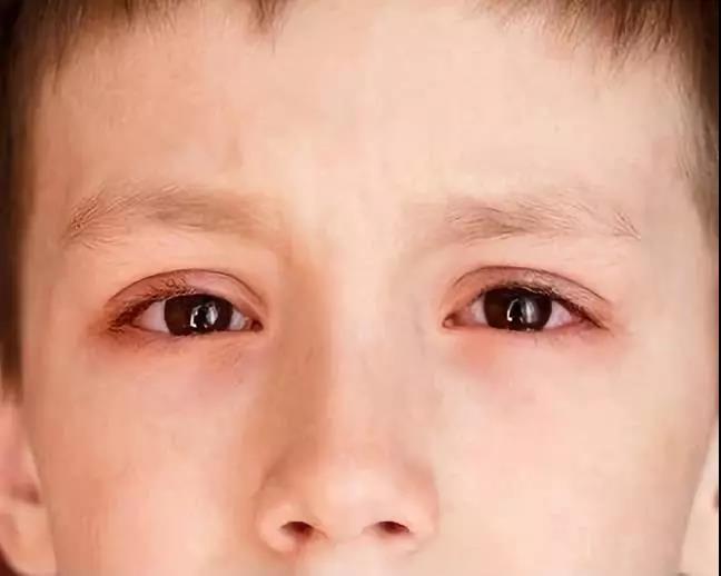 暑期正当时,生命汇提醒您孩子眼外伤要注意!