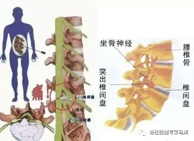 名医访谈:青少年椎间盘突出症常见问题