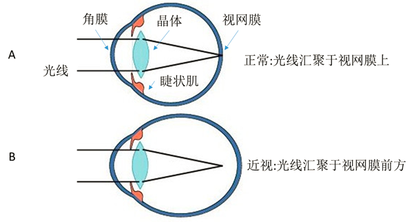 近视患者看远处的东西之所以模糊,主要是因为晶状体曲率变大或眼轴变