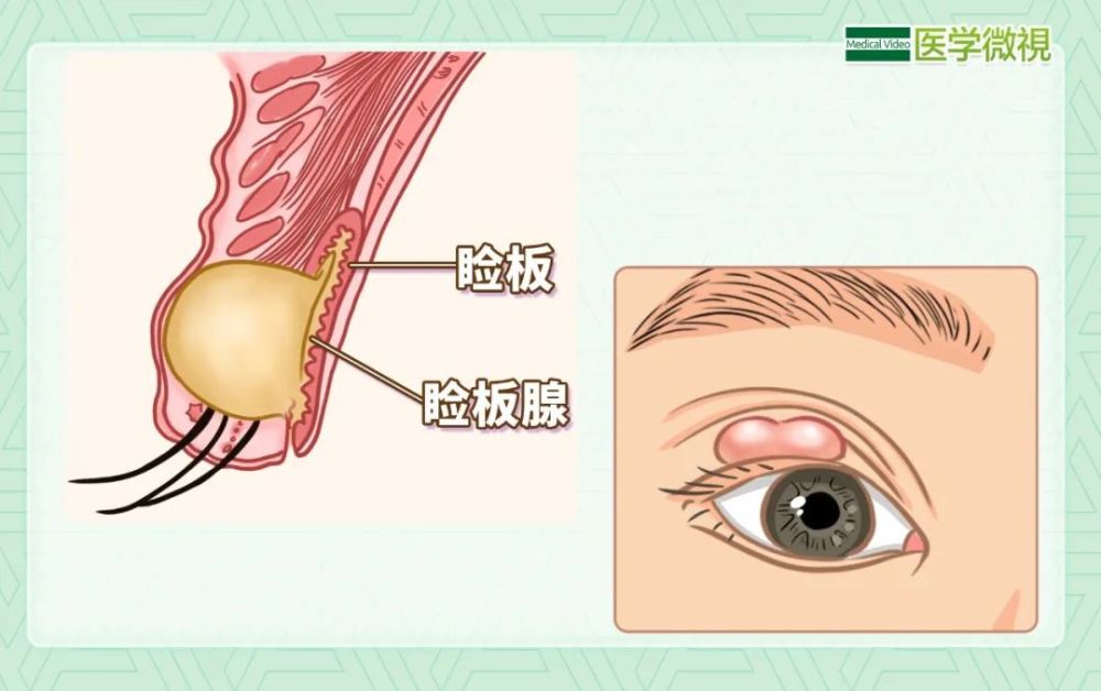 在我们的上下眼睑中,有一种特殊的腺体,名为睑板腺,它可以分泌油脂,起
