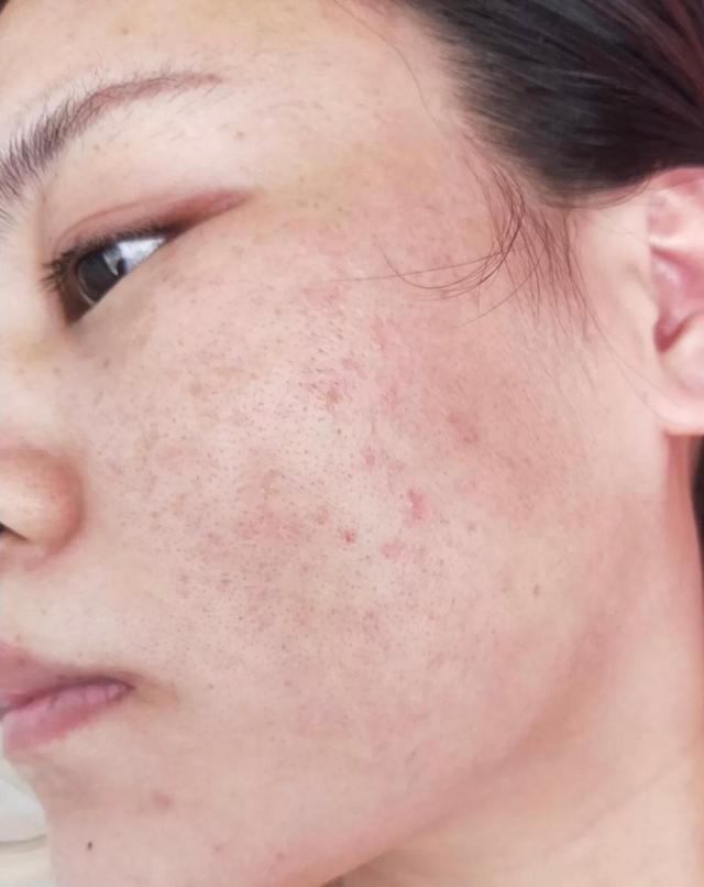 别再轻易"刷酸"了,对皮肤的危害也不小,你该知道一些真相了