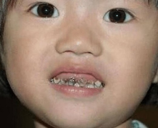 这小孩的家长表示自己的孩子很少吃糖,为什么牙齿全坏了呢?
