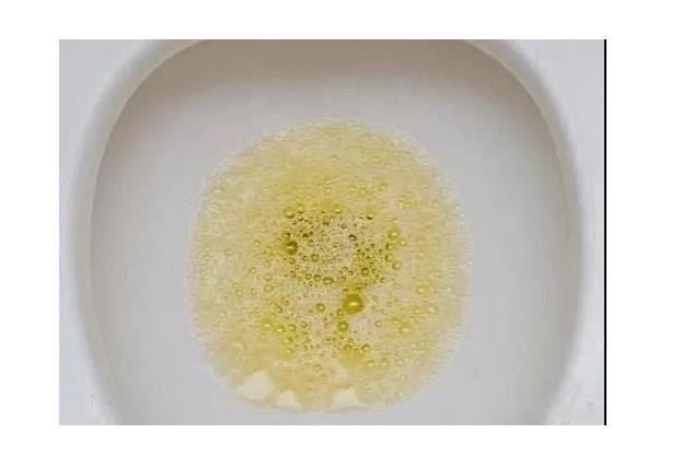 尿液中有泡沫是尿毒症吗?尿毒症早期的5个信号,要认清楚了!