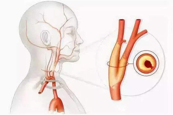 颈动脉斑块,是什么病?严重吗?是否需要治疗?听听医生