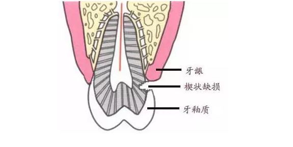 楔状缺损就是在牙齿和牙龈的交界处这个位置,也叫牙颈部,出现的一个