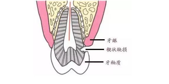 闫燕医生:楔状缺损是怎么造成的?