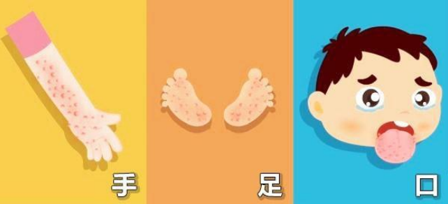 手足口病高发期,防控知识学起来