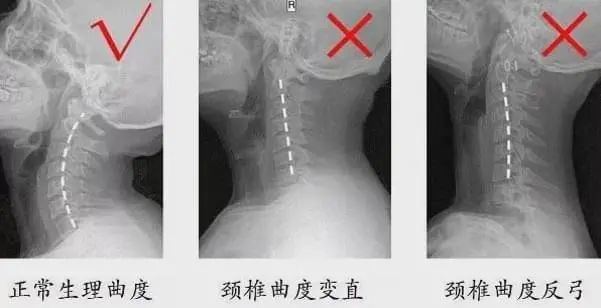 别搞错了你得的可能不是颈椎病